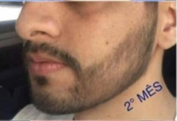 Homem com primeiros fios nascendo após 60 dias de uso